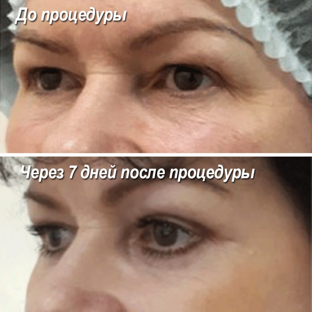 лазерная блефаропластика до и после lazernaya-blefaroplastika-do-posle-2.jpeg