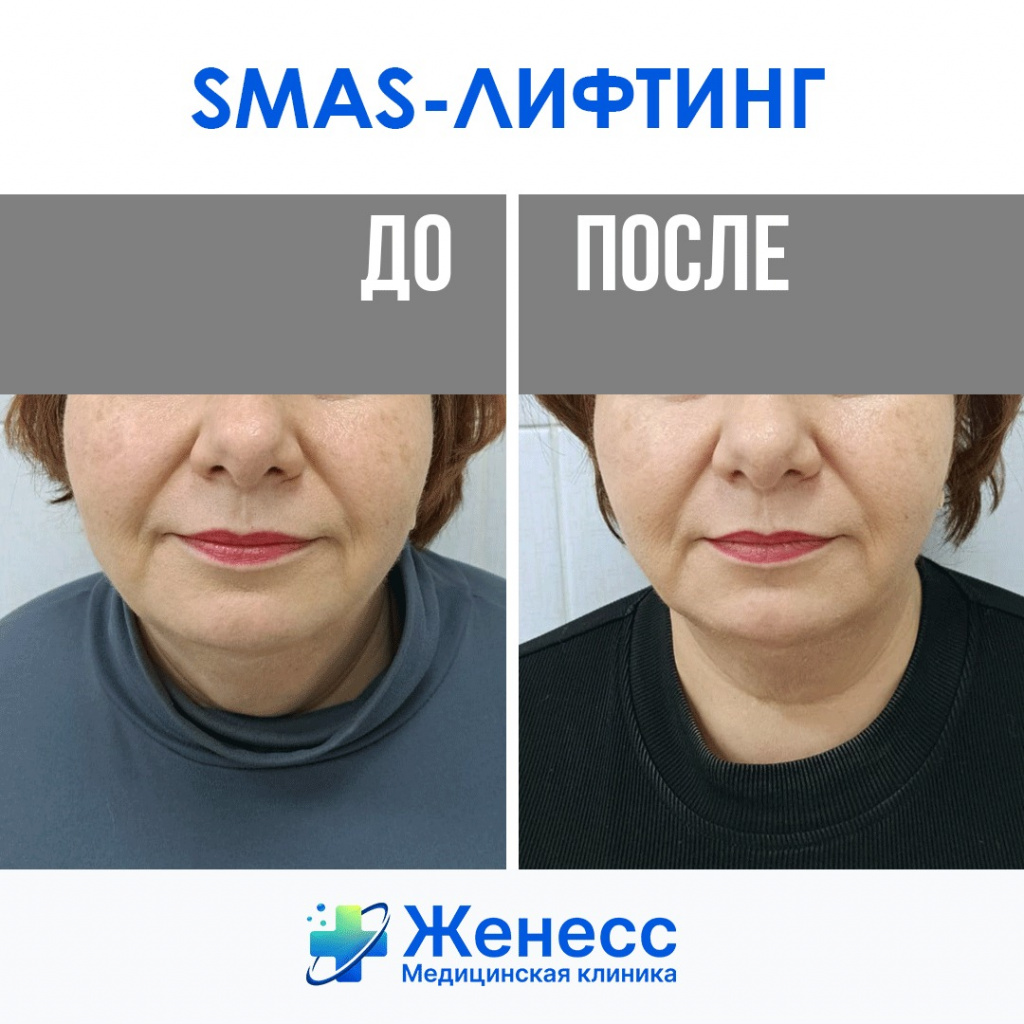 смас-лифтинг фото до и после смас-лифтинг фото до и после