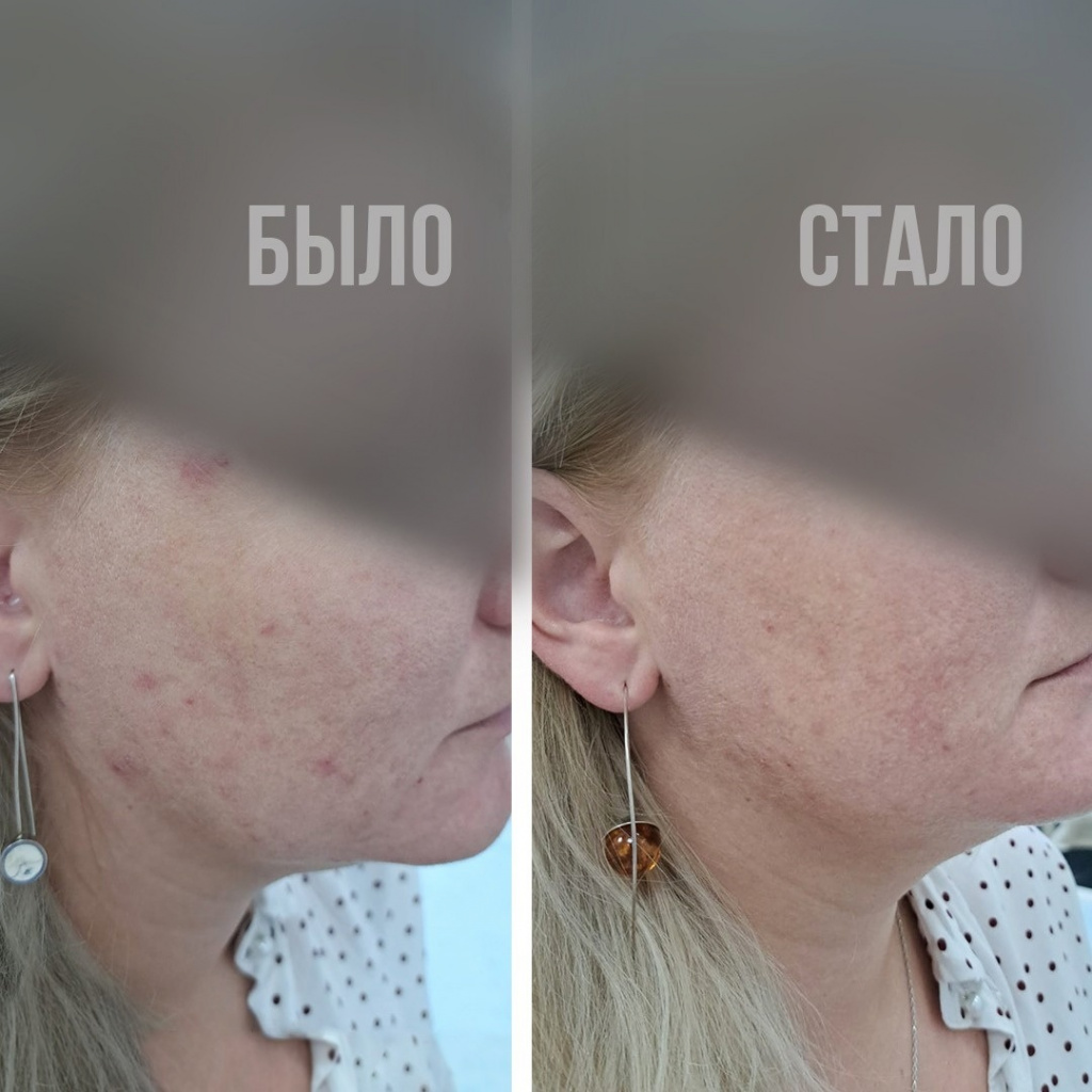 Плазмотерапия до и после Плазмотерапия до и после