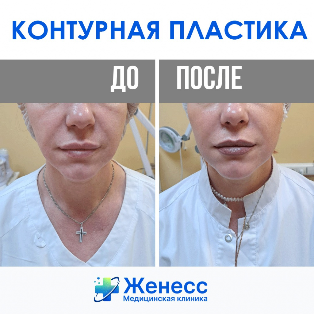 контурная пластика фото до и после контурная пластика фото до и после