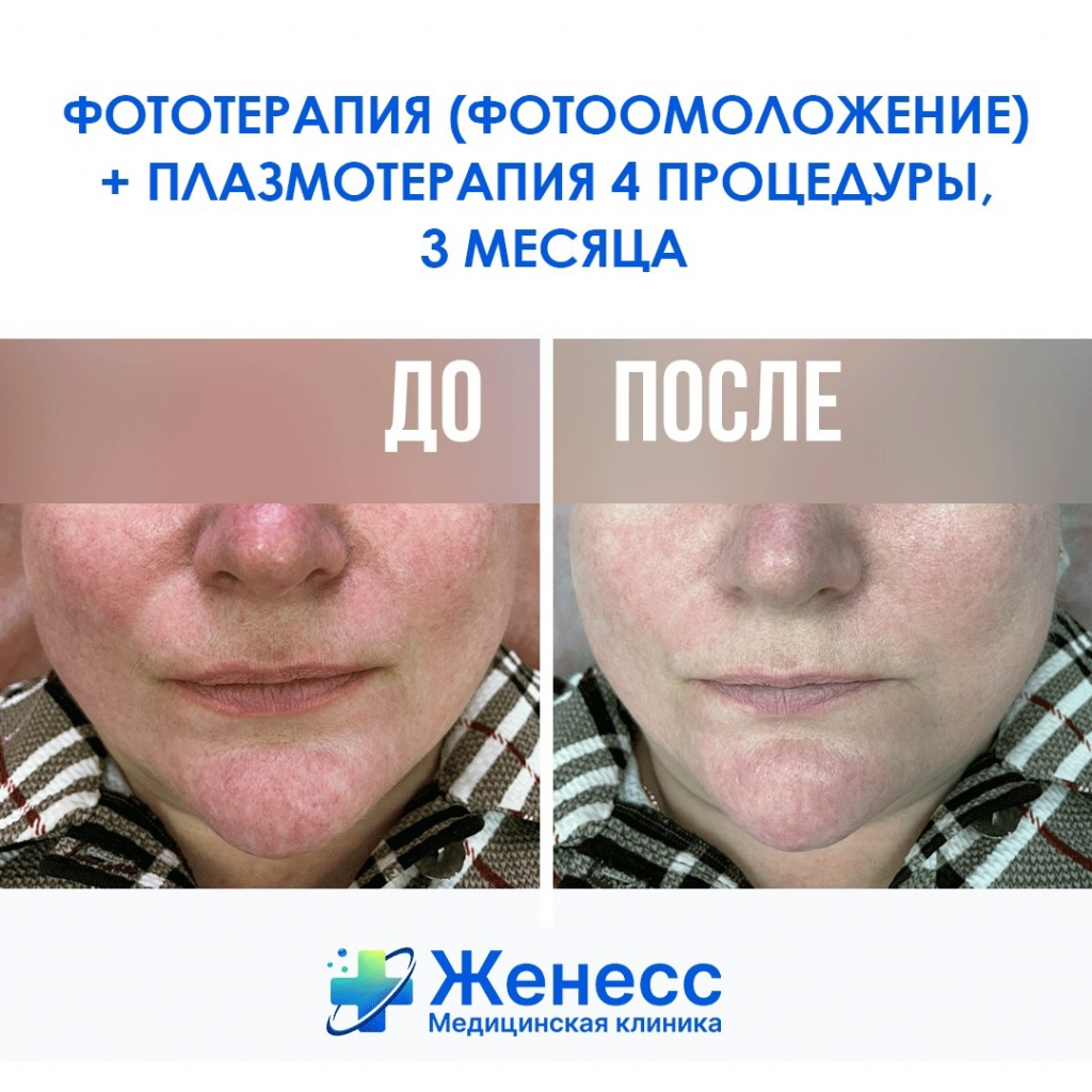 Фототерапия и плазмотерапия