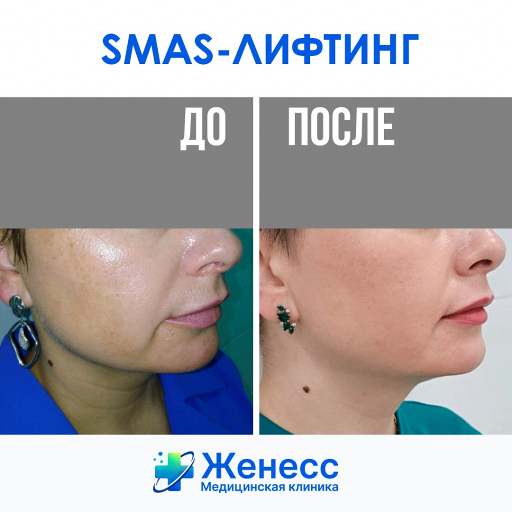 СМАС-лифтинг до и после СМАС-лифтинг до и после