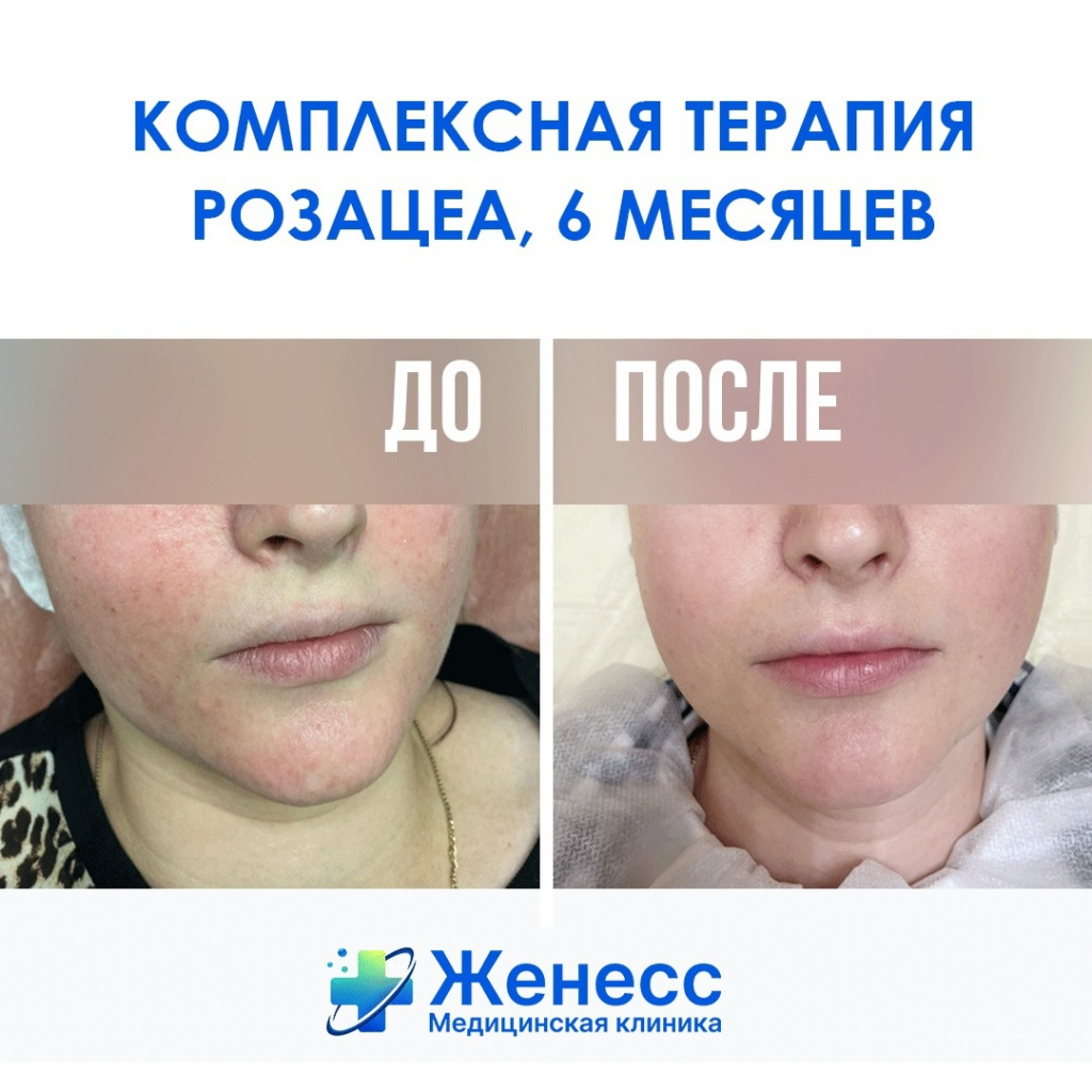 Терапия розацеа Терапия розацеа